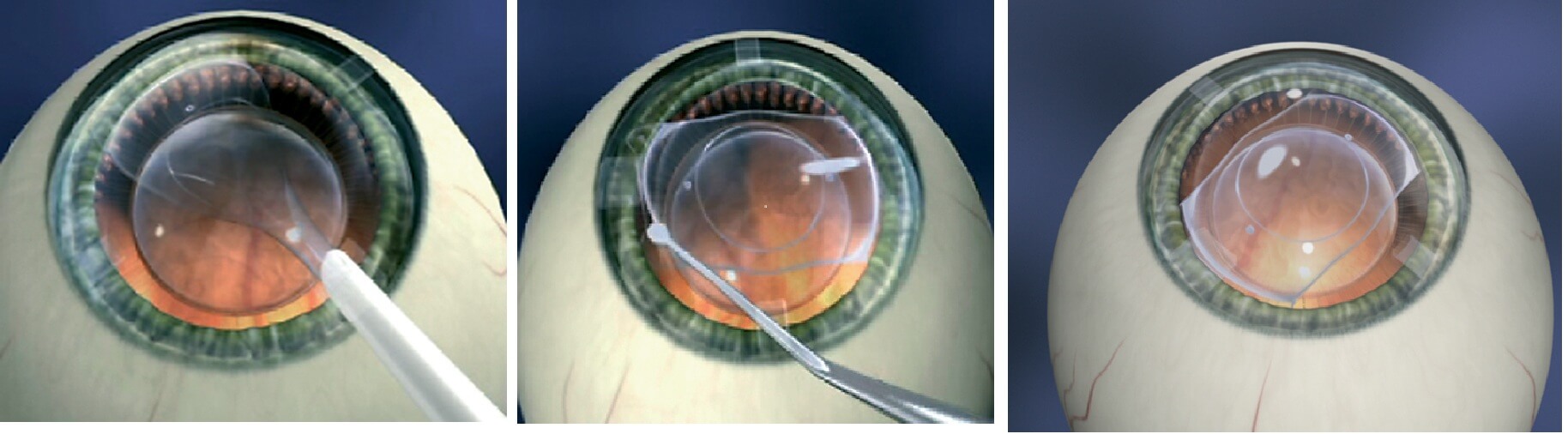 Что можно делать после операции катаракты