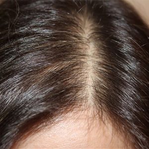 androgennaya-alopeciya