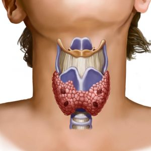 Болезни от недостатка йода в щитовидной железе thumbnail