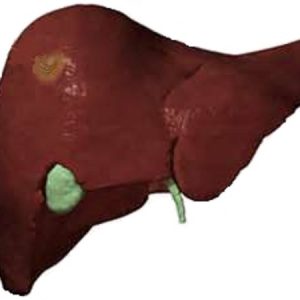 Pyogenic_liver_abscess