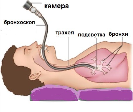 bronkhoskopiya