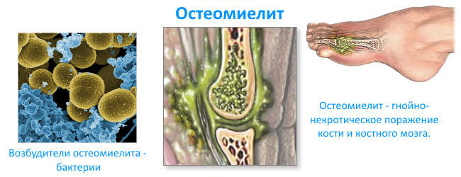 gemat-osteom