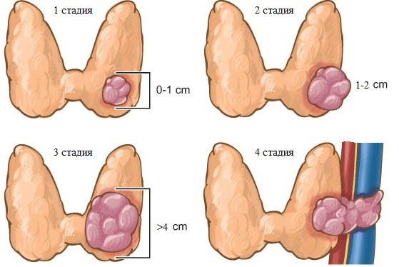 Папиллярный рак щитовидной железы