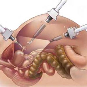 laparoskopiya-v-ginekologii