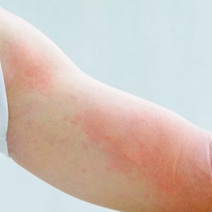 Через сколько проявляется аллергия на прививку