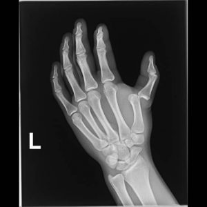 Вывих сустава пальца руки лечение thumbnail