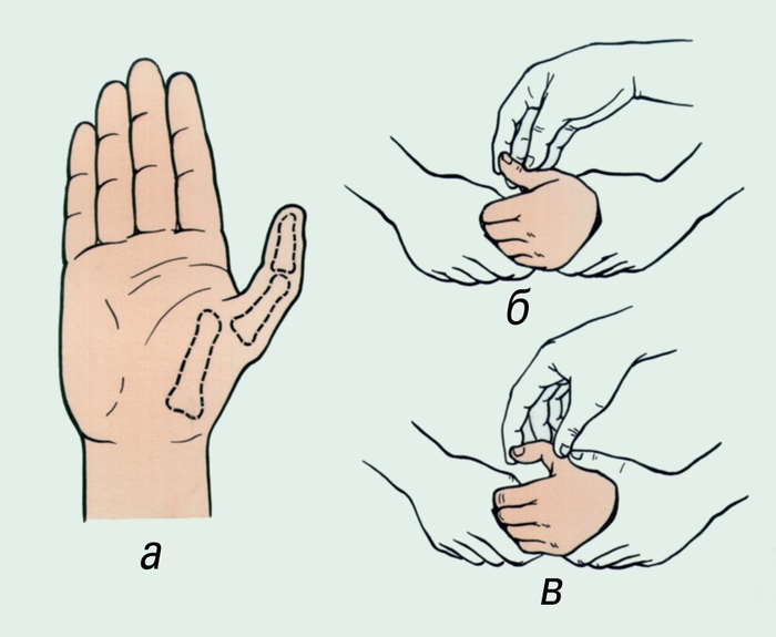 Вывих сустава среднего пальца руки лечение thumbnail