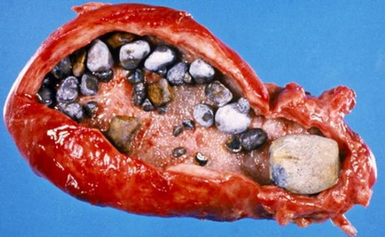Камень и песок в поджелудочной железе симптомы и лечение
