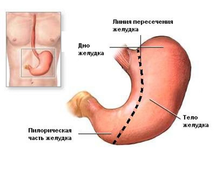 Операция удаления опухоли желудка. Резекция пилорической части желудка. Антральный отдел желудка. Объем резекции желудка.