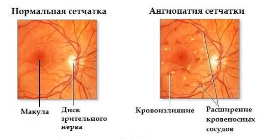 Ангиопатия сетчатки мкб 10. Диабетическая ангиопатия глазное дно. Гипертоническая ангиопатия сетчатки клиника. Ангиопатия сетчатки диагноз. Диабетическая ангиопатия сетчатки стадии.