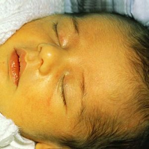 Причины хронического гепатита у детей