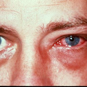 Антибиотики при инфекция глаз лечение