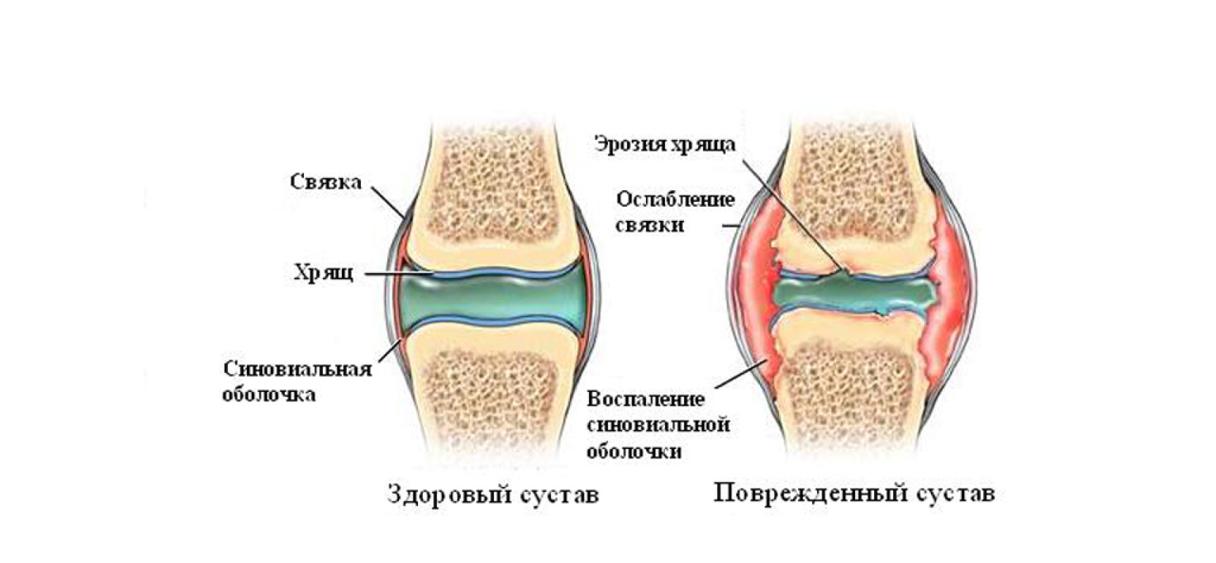 Артроз коленного сустава мениск. Остеоартроз синовиальная жидкость. Ювенильный ревматоидный артрит коленного сустава. Синовиальная жидкость в коленном суставе. Синовиальная жидкость и суставная жидкость.
