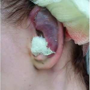 Как вылечить синяки на ушах