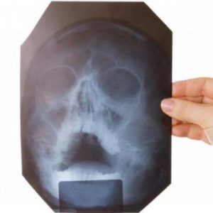 Противопоказания для рентгена пазух носа
