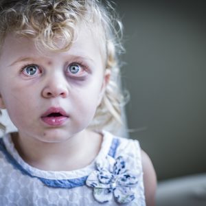 Сильный ушиб глаза у ребенка