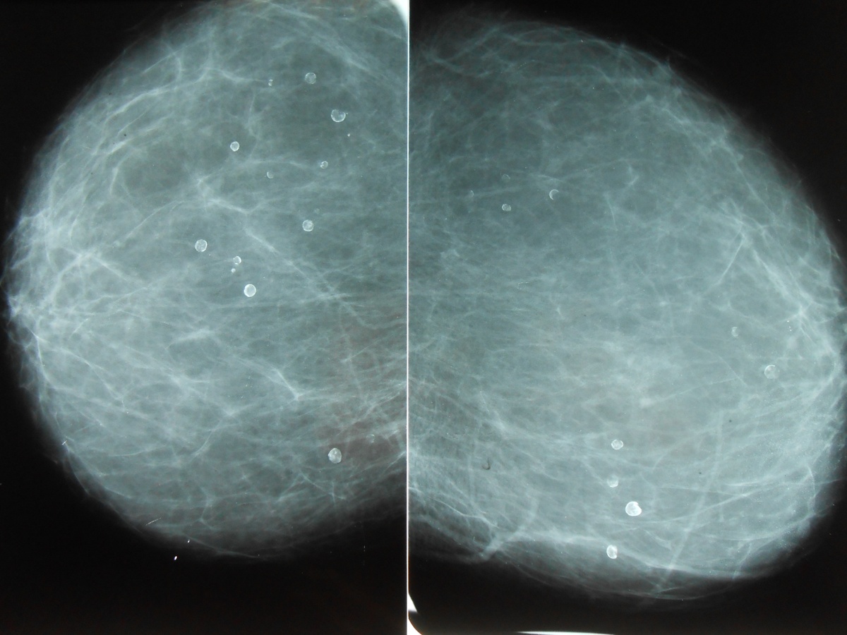 Маммография микрокальцинаты
