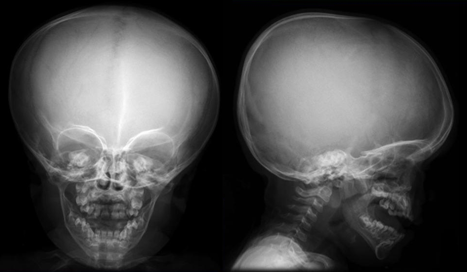 Детский череп рентген