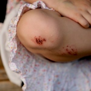 Как вылечить рану на ногах у детей thumbnail
