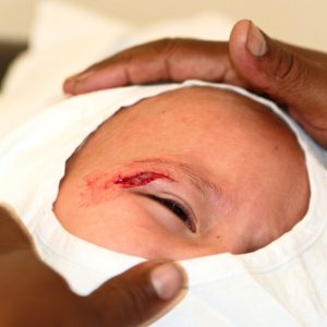 Как обрабатывать рану ребенка 1 года
