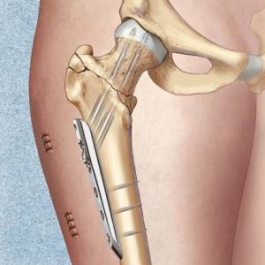 Оскольчатый перелом бедренной кости лечение