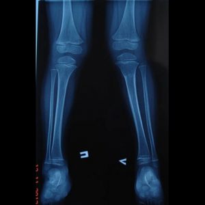 Искривление ног и их лечение в возрасте