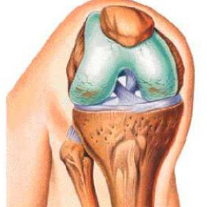 Лечение травматического артроза коленного сустава
