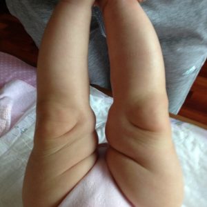 О образные ноги у ребенка лечение