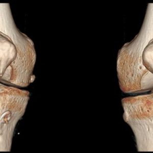 Посттравматический артроз коленного сустава 1 степени thumbnail
