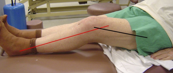 Разрыв наружного мениска коленного сустава лечение