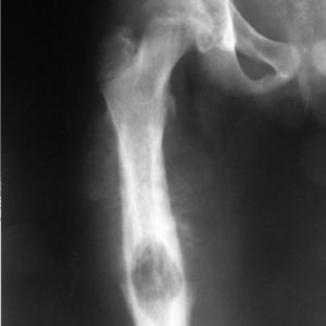 Закрытый оскольчатый перелом верхней трети бедренной кости
