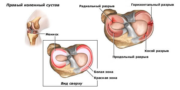 Разрыв мениска в коленном суставе лечение