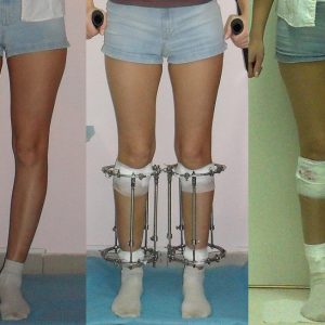 О образное искривление ног лечение