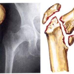 Оскольчатый подвертельный перелом бедренной кости со смещением