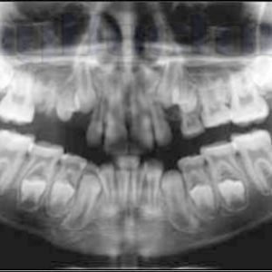 Рентгенологическое исследование зубов противопоказания