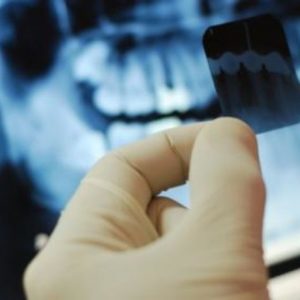 Противопоказания при рентгене зубов