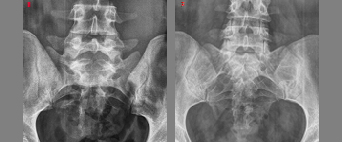 Перелом поясничного отдела позвоночника с повреждением спинного мозга thumbnail