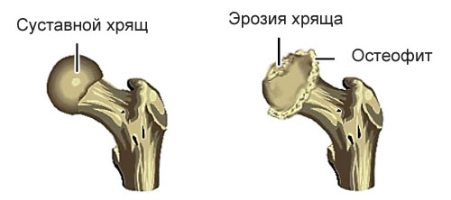 Посттравматический артроз правого тазобедренного сустава