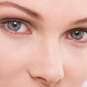 Покраснение белков глаз при глаукоме