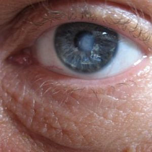 Белое пятно на роговице глаза человека thumbnail