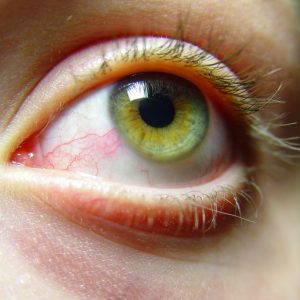 Покраснение белков глаз при глаукоме