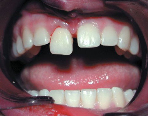 Лечение вывиха зуба