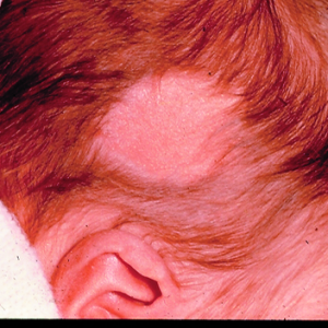 Аплазия кожи головы волосистой части головы