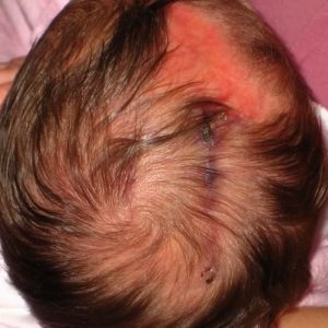 Дефект кожи головы у новорожденного