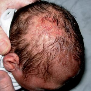 Аплазия кожи головы лечение