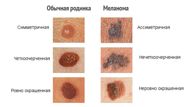 Онкомаркер меланомы кожи s 100