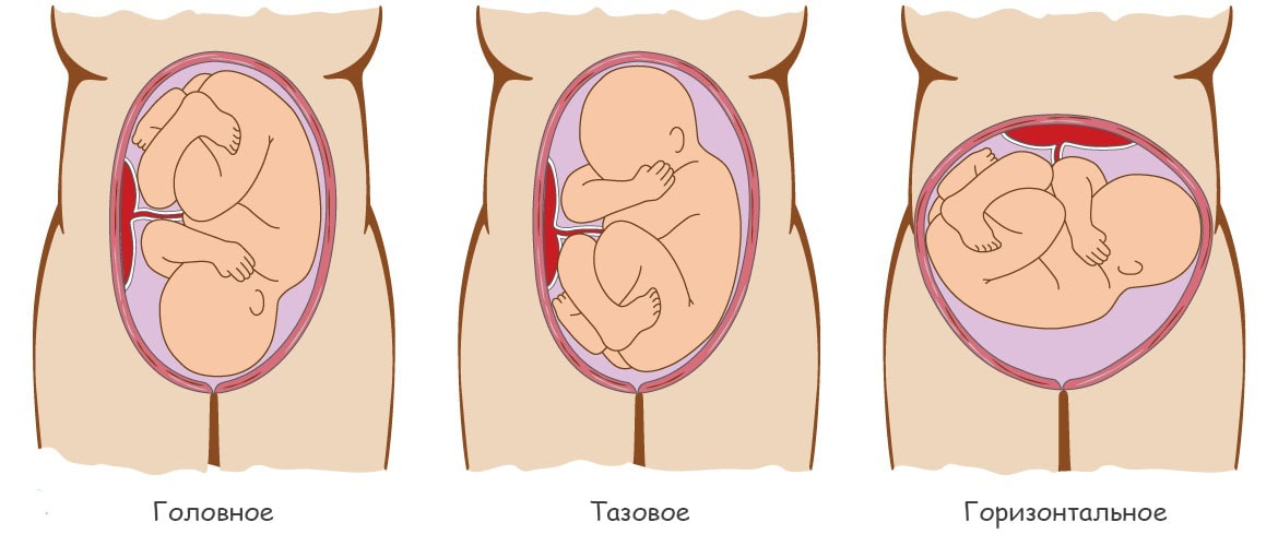 Ребенок расположен справа. Головное и тазовое предлежание плода. Головковое предлежание плода. Головное предлежание плода при беременности. Головное предлежание плода на 23 неделе беременности.