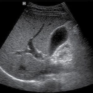Размеры желчного пузыря на узи норма у ребенка thumbnail