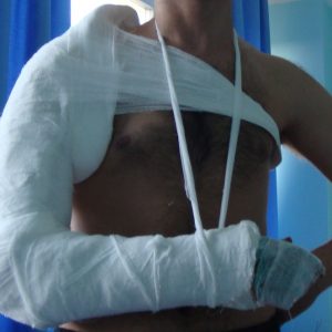 Лечение посттравматического артроза плеча