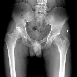 Подвывих тазобедренного сустава у взрослых симптомы фото лечение thumbnail